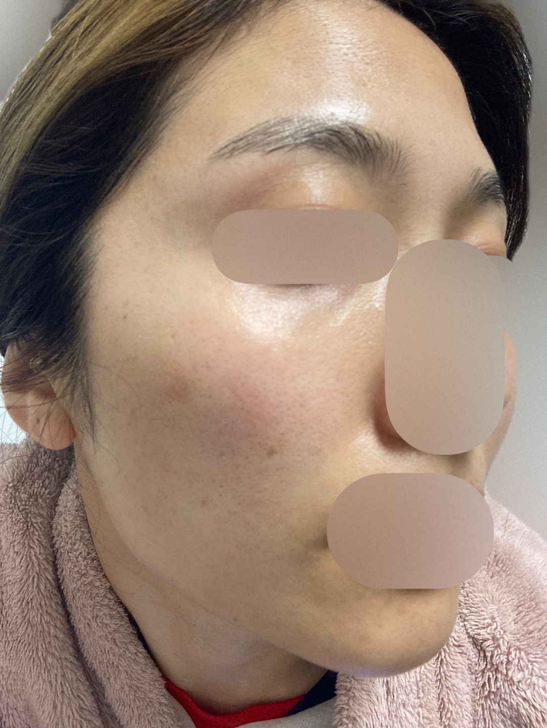 再来OK】ハイドラフェイシャル＋エレクトロポレーション | おおかみ