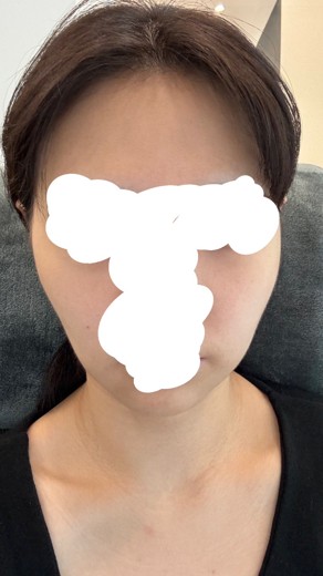 before photo: 실리프팅