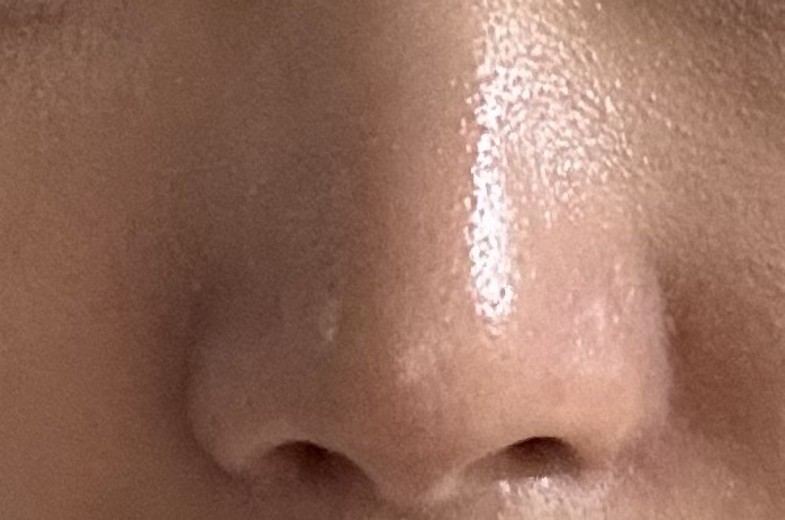 before photo: 콧볼축소