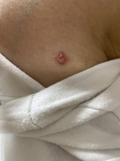 after photo: 豊胸(脂肪注入)