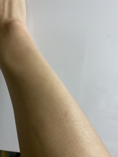 after photo: 팔제모, 종아리제모, 아포지레이저