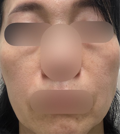 before photo: マッサージピール(コラーゲンピール)