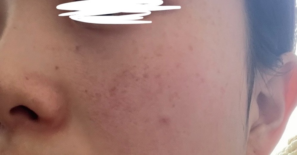 before photo: ルメッカ