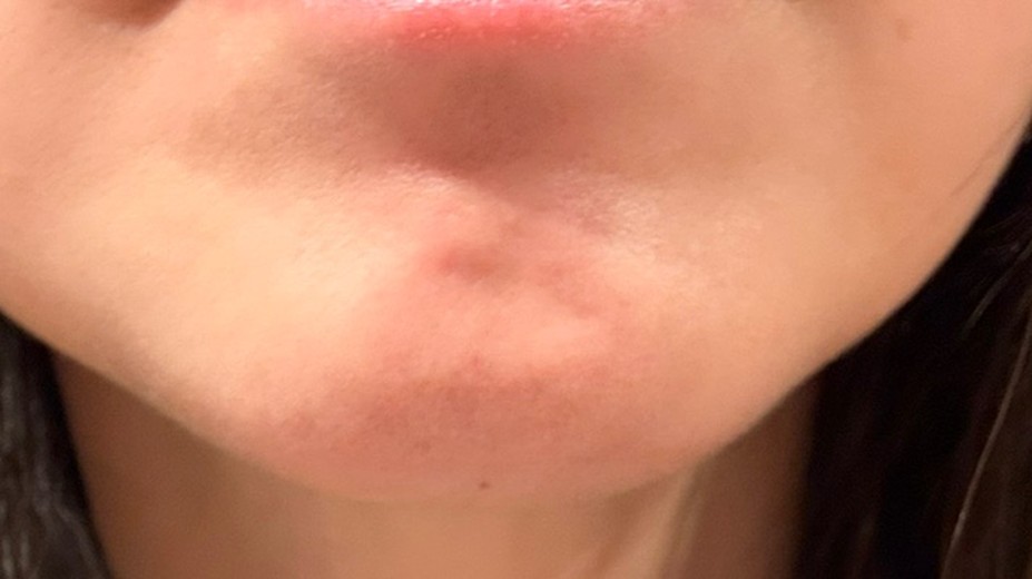 after photo: 美容注射・点滴