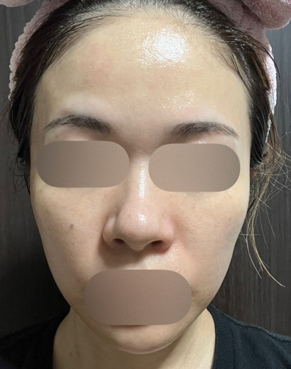 after photo: ピーリング, ルメッカ