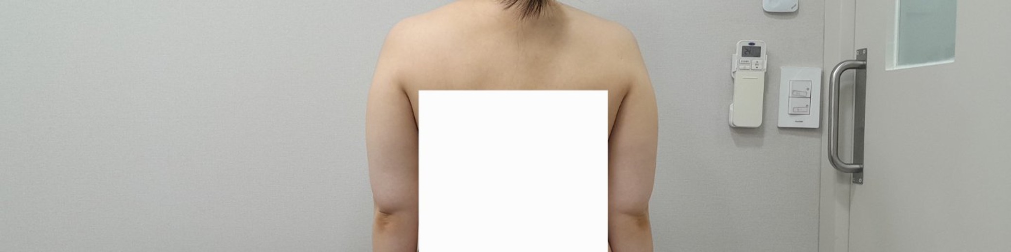 before photo: 脂肪吸引(腕)