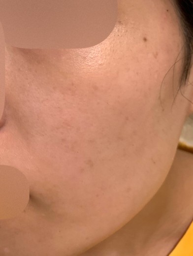 after photo: IPL(光/フォト治療), ルメッカ