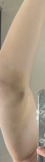 after photo: 脂肪吸引(腕)