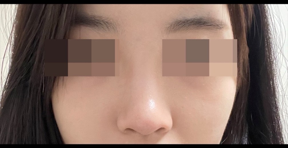 before photo: 콧볼축소