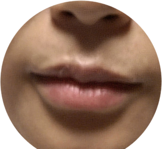 after photo: 입술필러