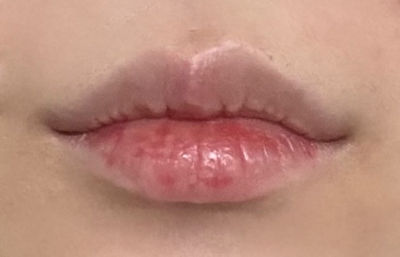 after photo: 입꼬리보톡스