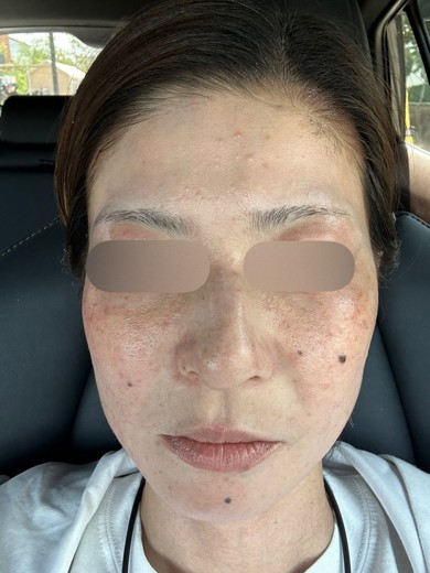 after photo: IPL(光/フォト治療), エレクトロポレーション