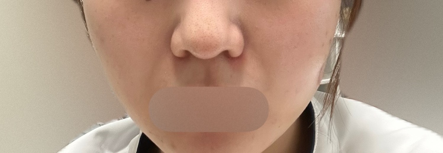 after photo: 脂肪溶解注射(顔)