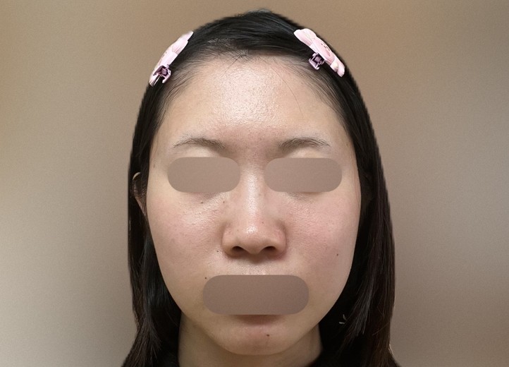 after photo: 脂肪溶解注射(顔)