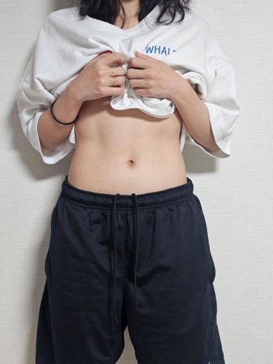 after photo: 복부지방분해주사