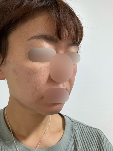 after photo: 糸リフト