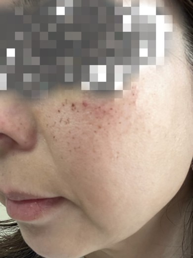after photo: ピーリング, ルメッカ