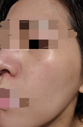 after photo: ハイドラフェイシャル, 診断・検査