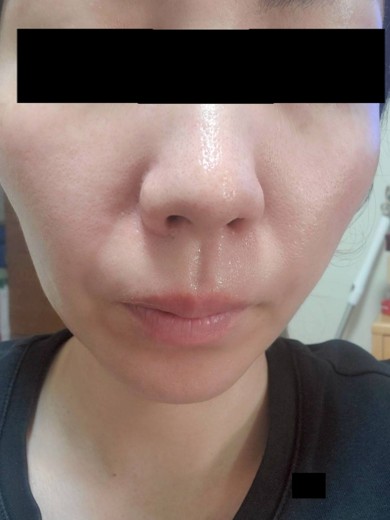 after photo: エレクトロポレーション