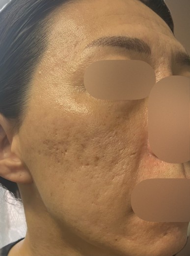 before photo: ダーマペン