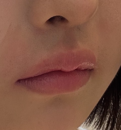 after photo: 입술필러