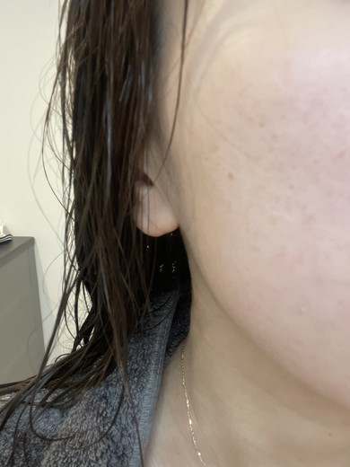 before photo: IPL(光/フォト治療)