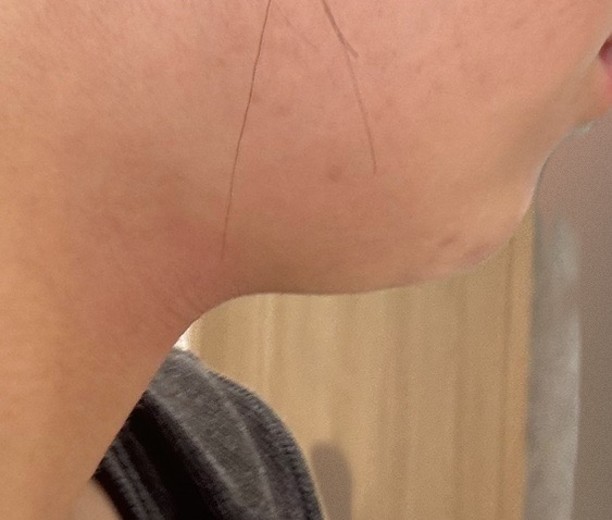 before photo: 脂肪溶解注射(顔)