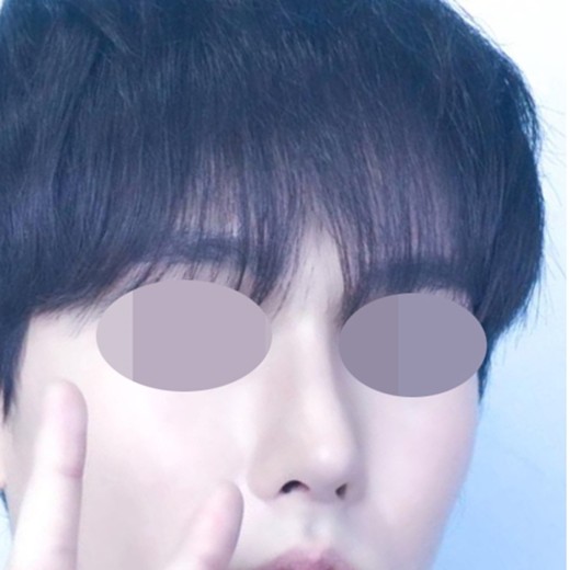 after photo: 콧대(자가조직), 코끝(자가연골)