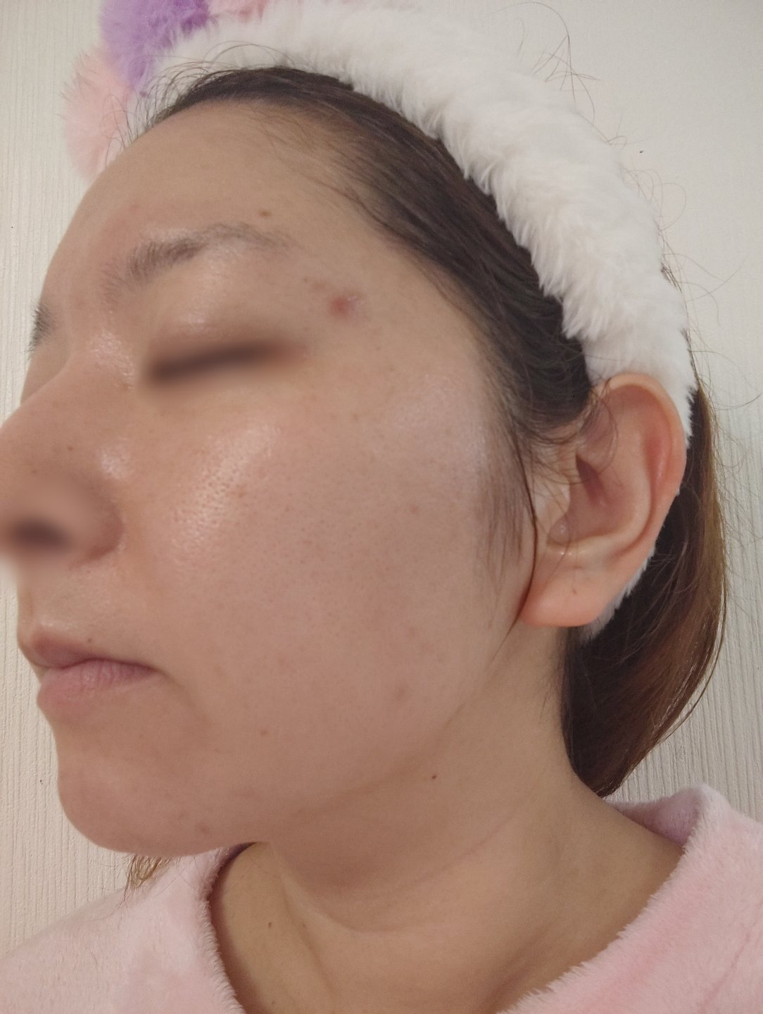 全顔シミ取り放題＋美顔レーザートーニング【3月15日迄にご予約頂いた