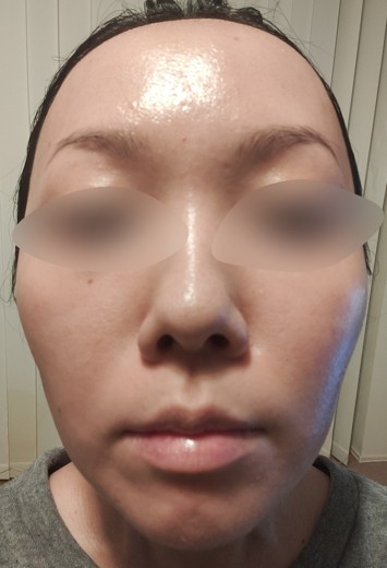 after photo: 水光注射