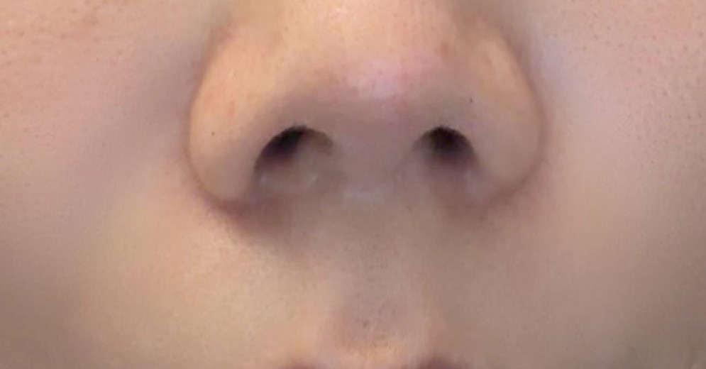 after photo: 실리프팅, 팔자주름필러