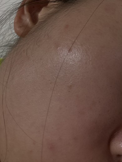 before photo: 스킨스케일링, 여드름압출