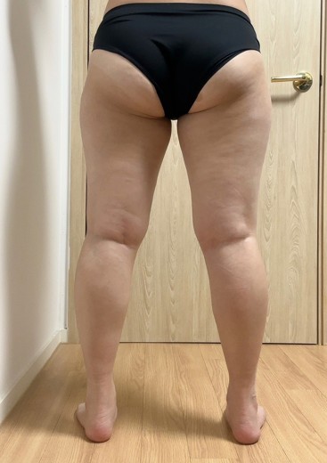 before photo: 허벅지지방흡입