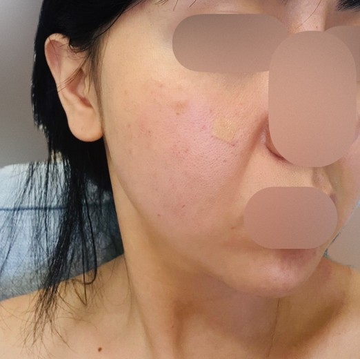 before photo: PRP피부재생술