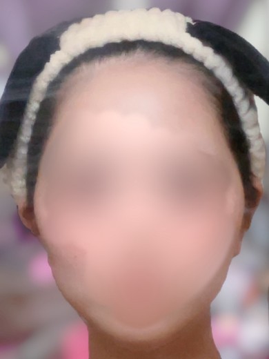 after photo: 脂肪溶解注射(腕), 脂肪溶解注射(顔)