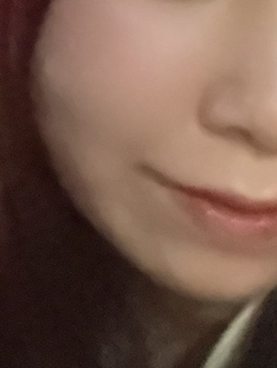 before photo: 脂肪吸引注射