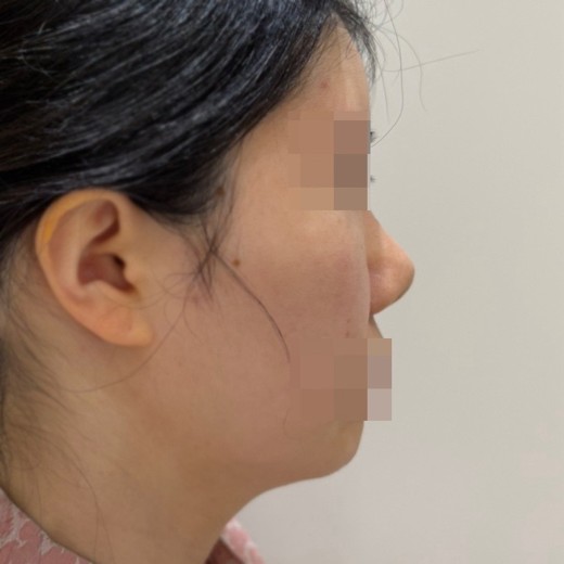 before photo: 코재수술, 콧대(보형물), 복코교정(수술)