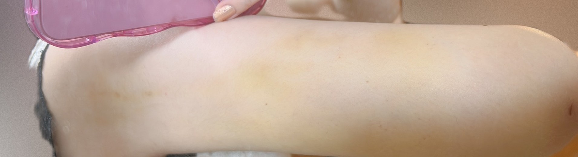 after photo: 脂肪吸引(腕)
