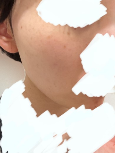 before photo: ピーリング
