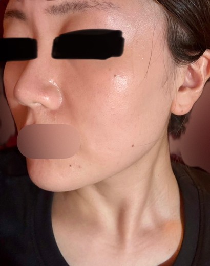 after photo: ピーリング, イオン導入