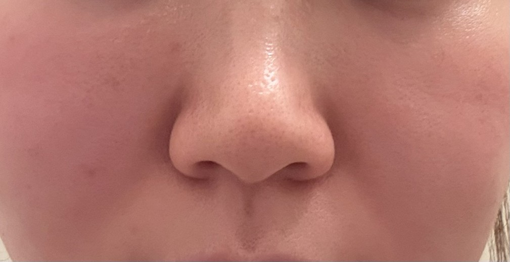 before photo: 脂肪溶解注射(顔)