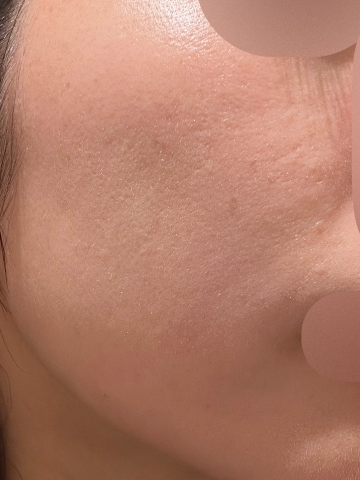 ララピール＋エレクトロポレーション（全顔＋首・1回）【再来OK