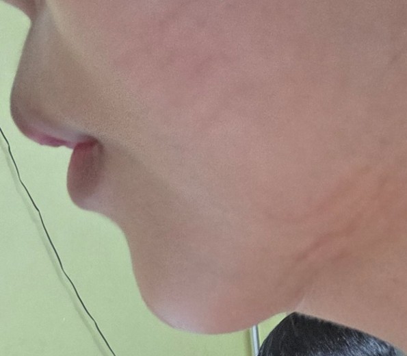 after photo: 입술필러