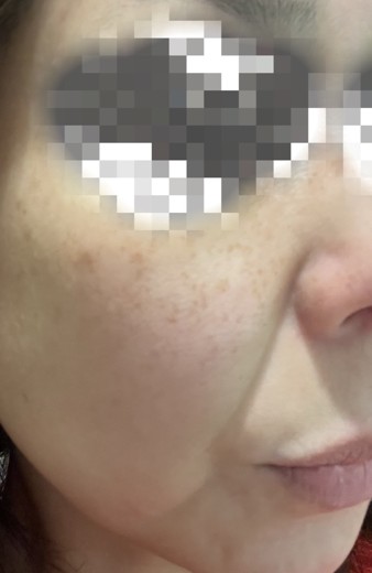 before photo: ピーリング, ルメッカ