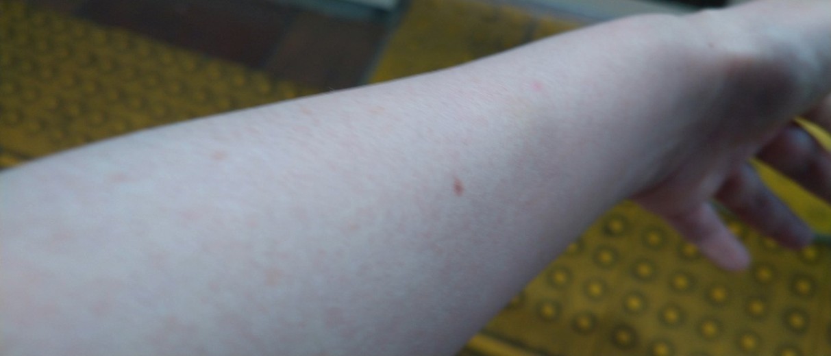 after photo: 白玉注射・点滴, ビタミン注射・点滴