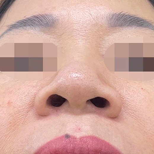 before photo: 콧볼축소