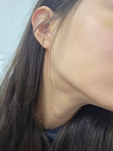 after photo: 침샘보톡스