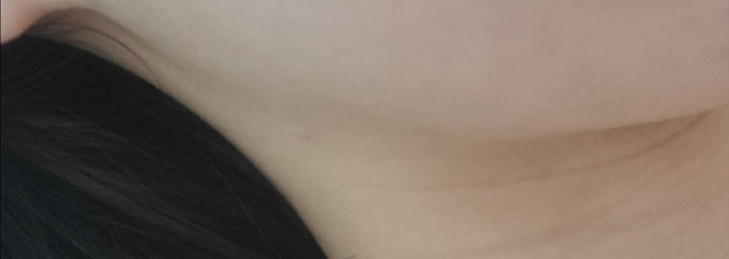 after photo: 윤곽주사