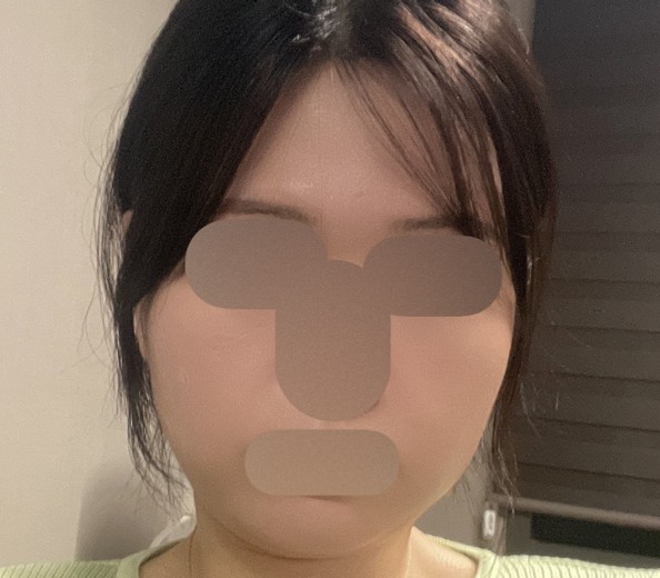 after photo: 여드름주사, 네오빔