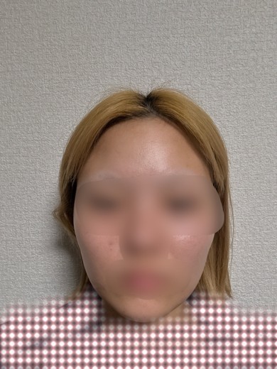 before photo: インモード